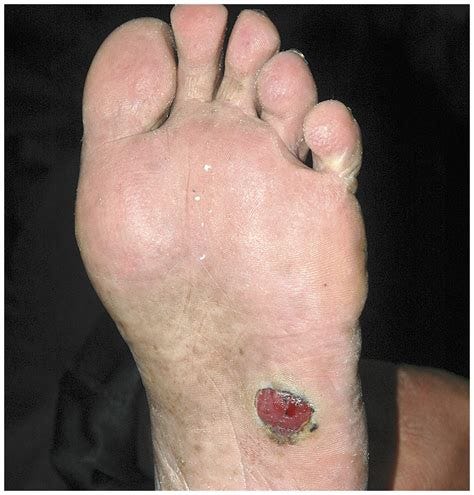 Melanoma of the Foot | NEJM
