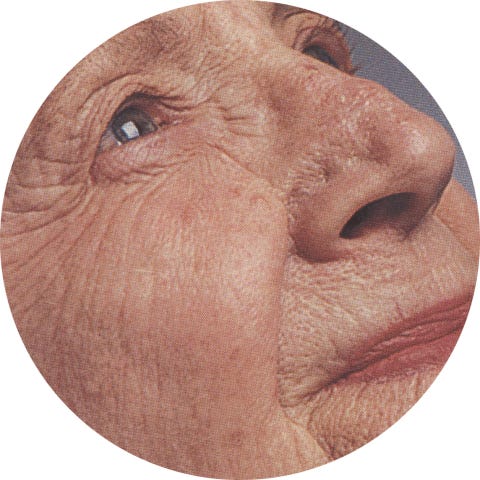 Estágio avançado de envelhecimento que pode ser identificado como um nível Glogau 4