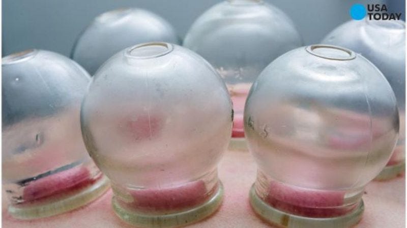 cupping technigque cupping technigque