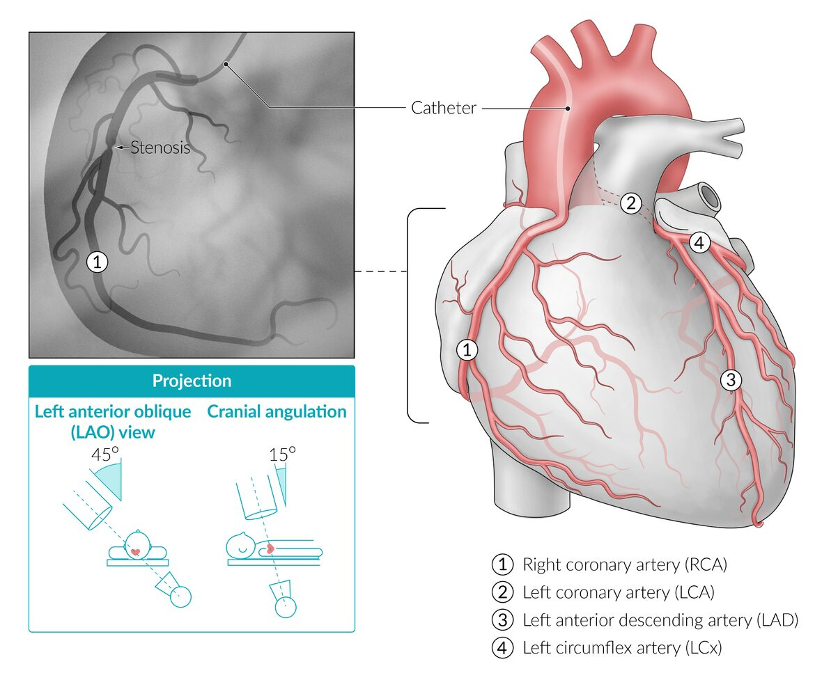 Myocardial infarction - Knowledge @ AMBOSS