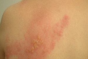 shingles on shoulder