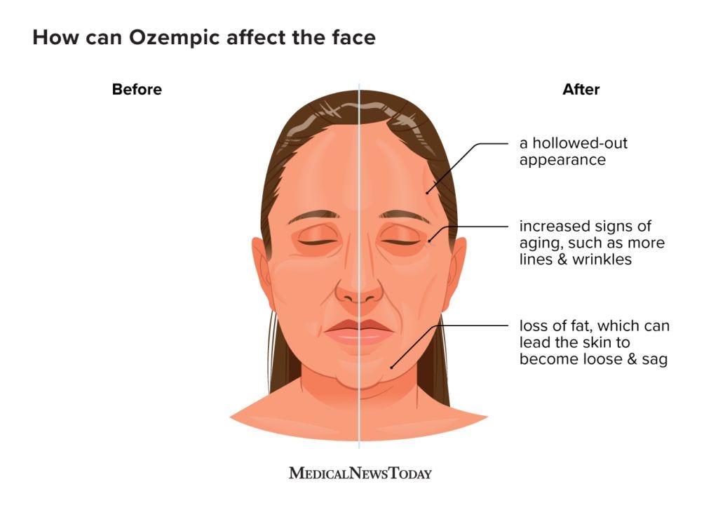 What to know about "Ozempic Face"