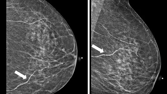 Breast arterial calcifications (BACs) identified on screening mammograms may help identify women who face a heightened risk of developing cardiovascular disease (CVD), according to a new analysis published in Clinical Imaging. Breast arterial calcifications (BACs) identified on screening mammograms may help identify women who face a heightened risk of developing cardiovascular disease (CVD), according to a new analysis published in Clinical Imaging.
