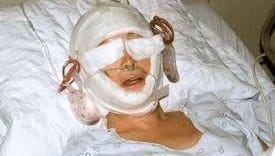 Lynn's Face Lift Surgery