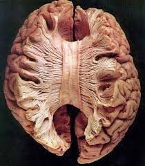 The corpus callosum (Latin for "tough body"), also callosal commissure, is  a wide, thick nerve tract, consisting of a flat bundle of commissural  fibers, beneath the cerebral cortex in the brain. The