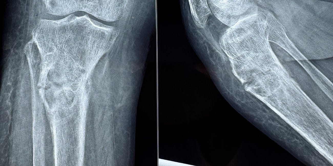 Case 75 - A Proximal Tibial Lesion with a Pathologic Fracture