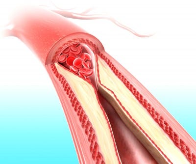How To Clean Your Arteries With One Simple Fruit