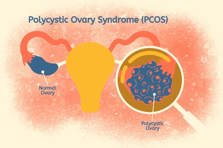 'PCOS'