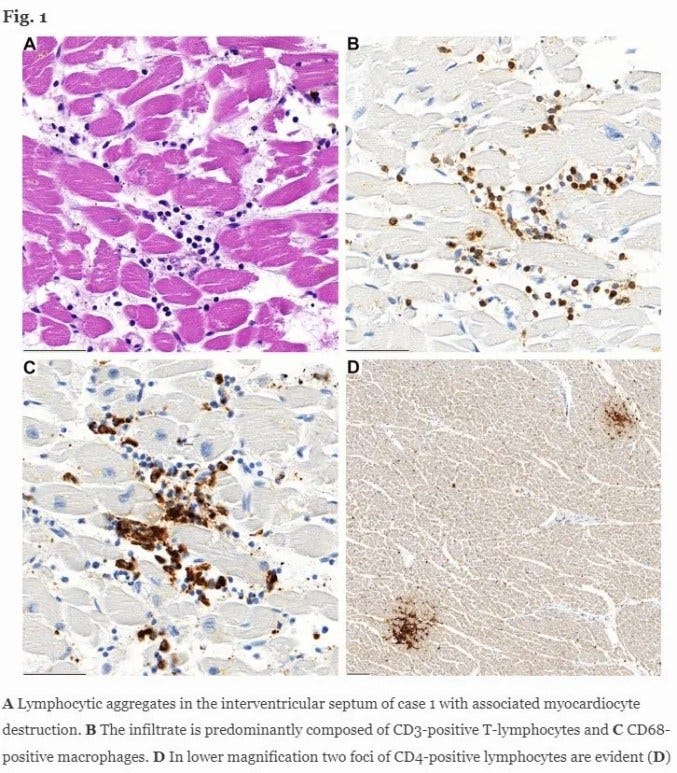 Lymphocyte immune cells (white blood cells) are shown in blue and brown among the heart tissue, causing localised inflammation that proved fatal Lymphocyte immune cells (white blood cells) are shown in blue and brown among the heart tissue, causing localised inflammation that proved fatal