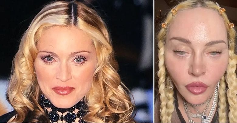 Madonna Plastic Surgery