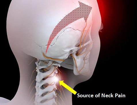Occipital Neuralgia