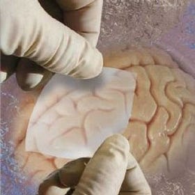 Endotoxin forced Recall of Durepair Dura Regeneration Matrix