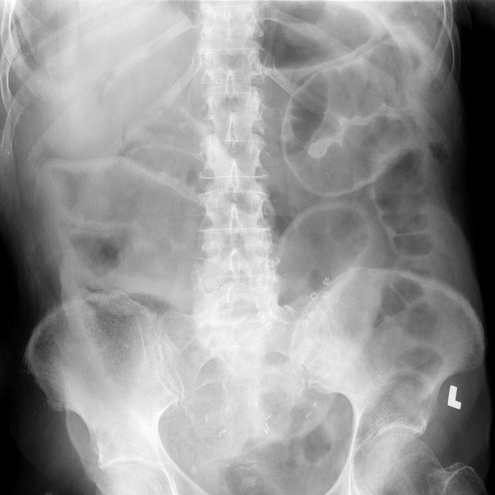 Fabs Radiography Perforated Duodenal Ulcer Radiology
