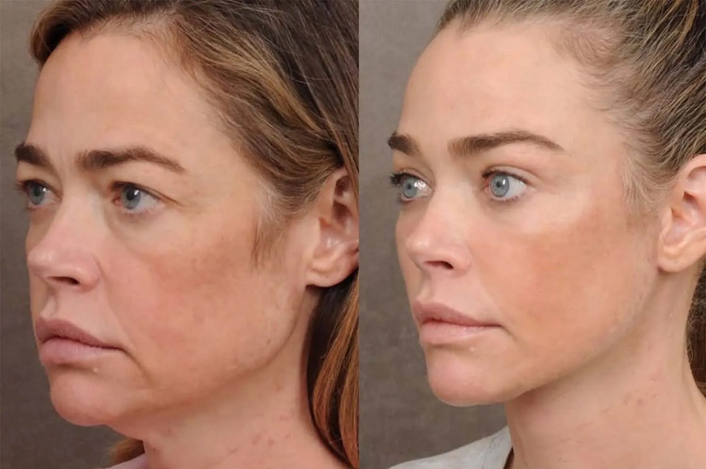  Denise Richards Shares Before and After Photos of Her âShockingâ Facelift Transformation