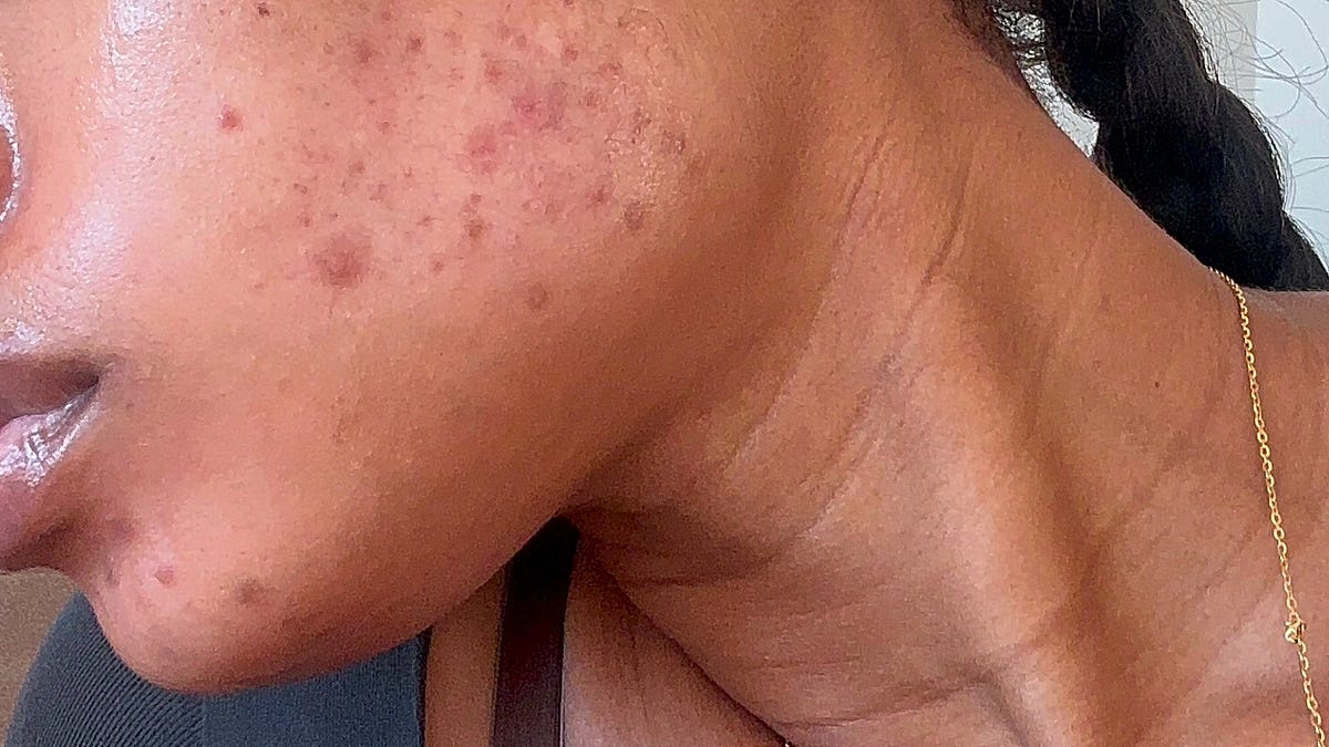 How I Got Rid of My Acne - by Toluwani Olu-Alakija