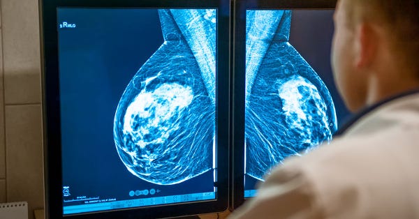 Reclassifying DCIS: A Groundbreaking Shift in Breast Cancer Diagnosis After Over a Decade of Advocacy
