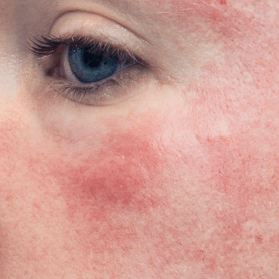 Retinoid Rash Retinoid 101: everything you need to know
