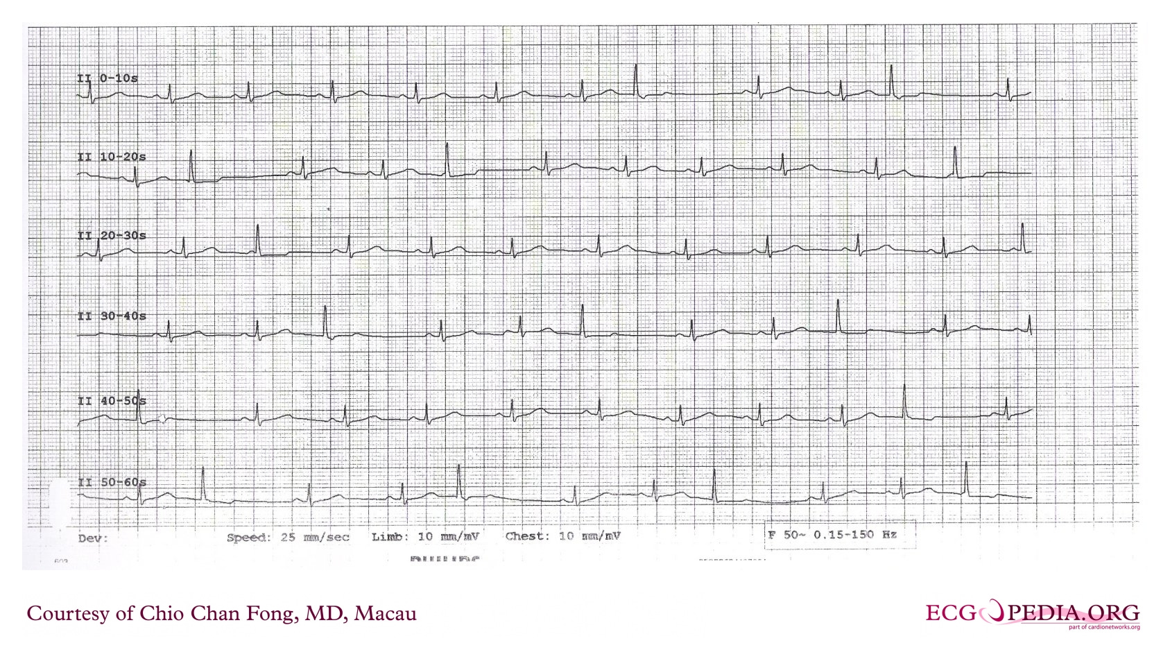 Continuous 60-second lead II rhythm strip with narrow QRS complexes and intermittent wider QRS complexes. Continuous 60-second lead II rhythm strip with narrow QRS complexes and intermittent wider QRS complexes.