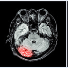 Andexanet vs prothrombin concentrate complex for intracranial hemorrhage (ANNEXA-I trial)