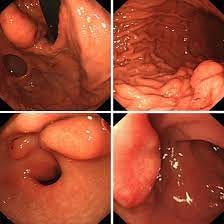 Multiple gastric angiolipomas: A case report