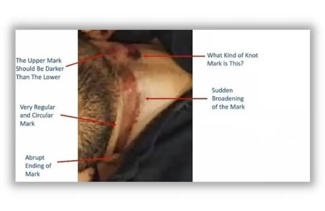 Mark on the neck of Sushant Singh Rajput indicates murder