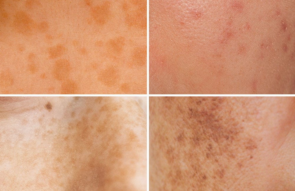 Hyperpigmentation & Melasma Through A Circadian Lens