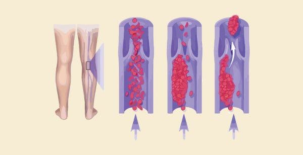 Chronic Venous Insufficiency vs Deep Vein Thrombosis, Navigating Vascular  Health – Knya