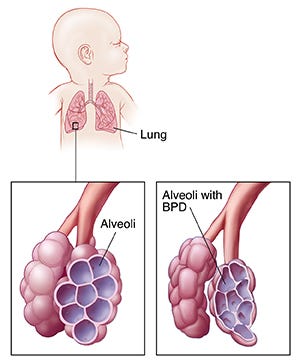 Text - Understanding Bronchopulmonary Dysplasia (BPD) Text - Understanding Bronchopulmonary Dysplasia (BPD)