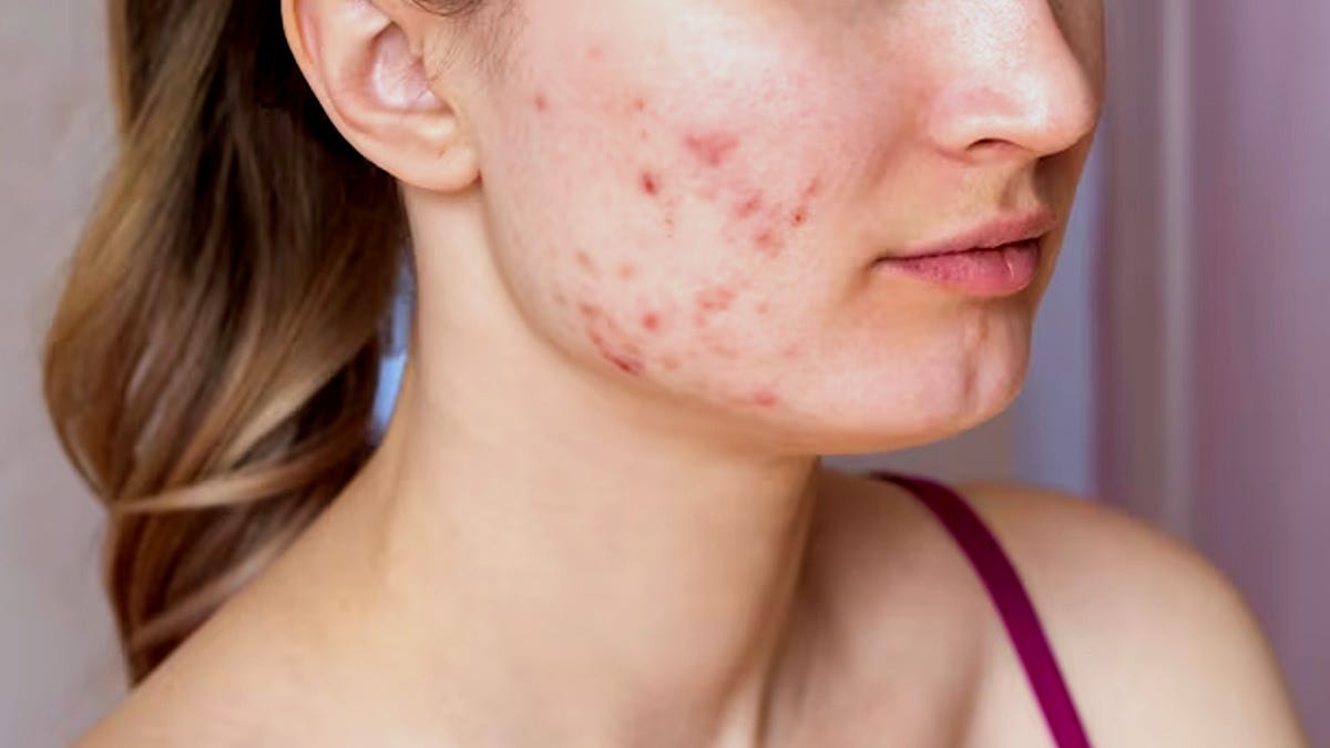 Hormonal Acne: Expert Explains The Connection And Treatment Measures ...