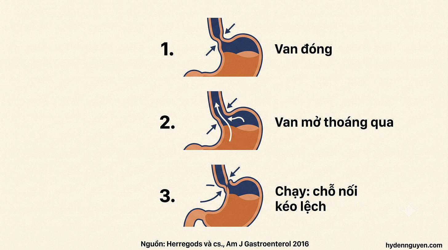 Sơ đồ minh họa cơ chế trào ngược khi chạy theo Herregods 2016: cơ thắt thực quản dưới (chiếc van) không mở nhiều lần hơn khi chạy, nhưng mỗi lần mở thoáng qua lại dễ đi kèm trào ngược; chỗ nối thực quản–dạ dày bị kéo lệch ngay trong buổi tập. Sơ đồ minh họa cơ chế trào ngược khi chạy theo Herregods 2016: cơ thắt thực quản dưới (chiếc van) không mở nhiều lần hơn khi chạy, nhưng mỗi lần mở thoáng qua lại dễ đi kèm trào ngược; chỗ nối thực quản–dạ dày bị kéo lệch ngay trong buổi tập.