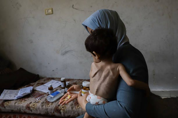 Mother of the 3-year-old child Amjed Al-Qanooa, who suffers from severe malnutrition, shows the pills prescribed for her son in the Jabalia Camp in...