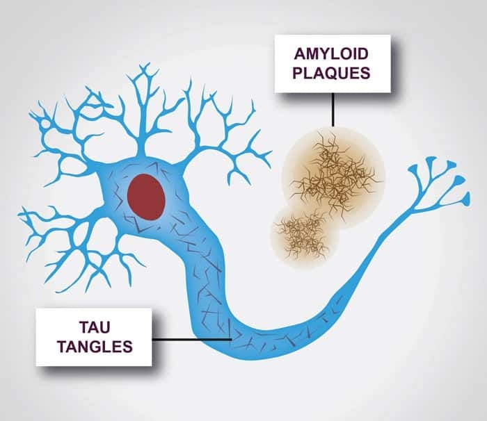 Untangling tau in the brain - Alzheimer's Research UK Untangling tau in the brain - Alzheimer's Research UK