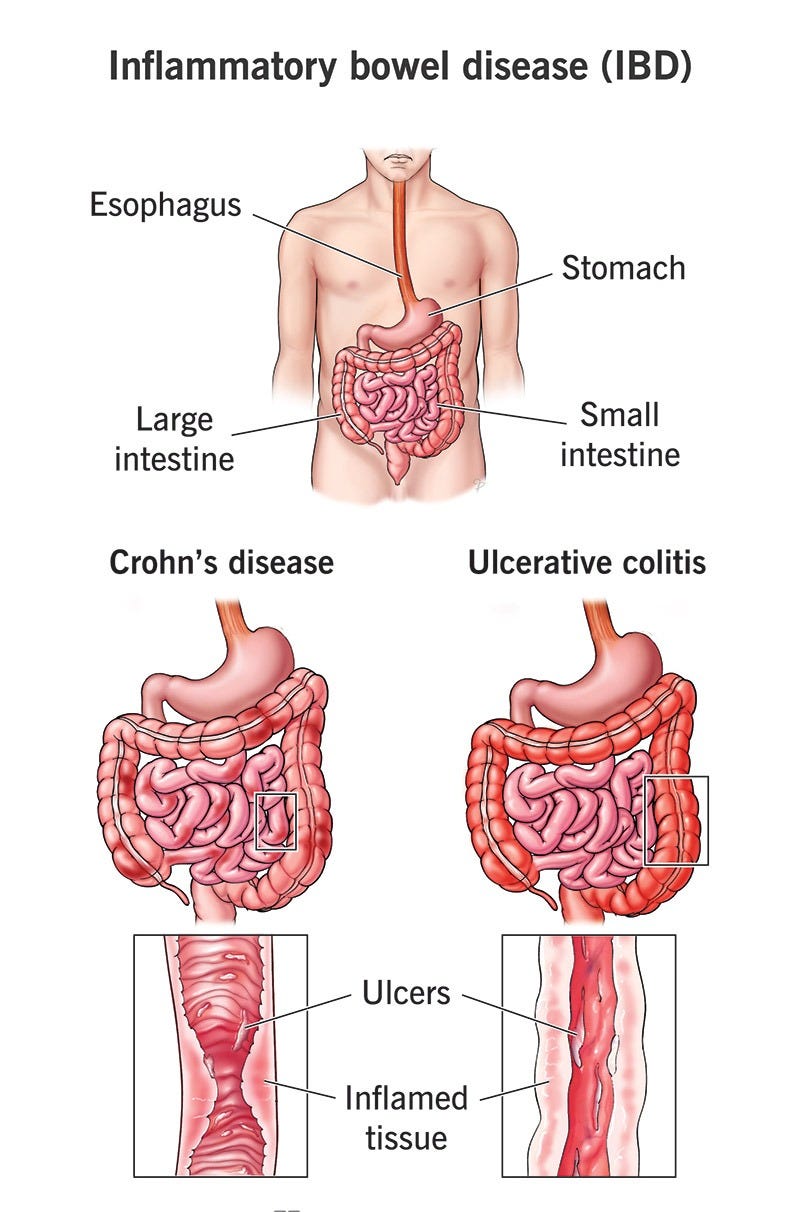 Crohn’s disease (bottom left) and ulcerative colitis (bottom right) are the main types of inflammatory bowel disease (IBD)