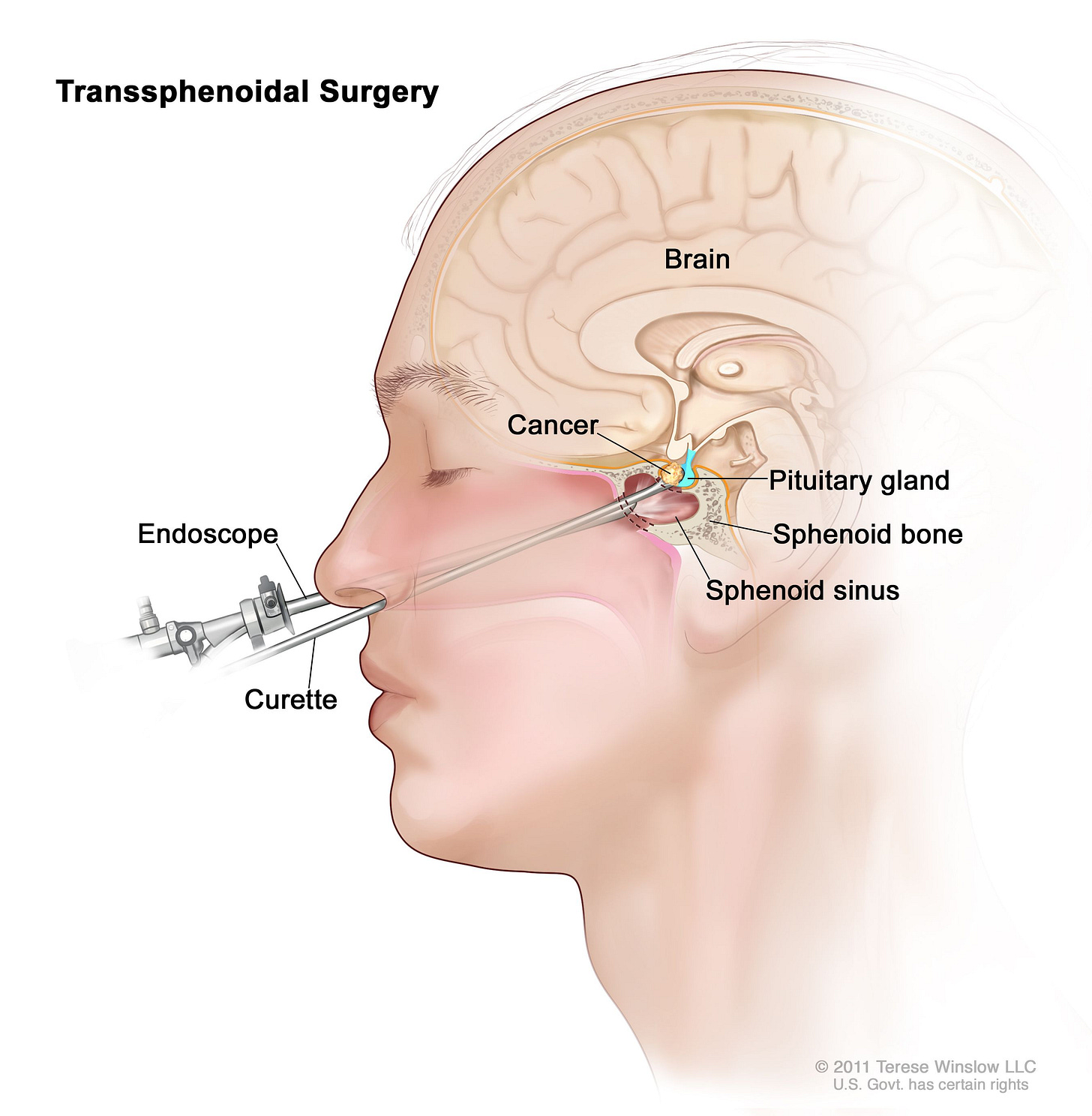 Definition of transsphenoidal surgery - NCI Dictionary of Cancer Terms - NCI Definition of transsphenoidal surgery - NCI Dictionary of Cancer Terms - NCI