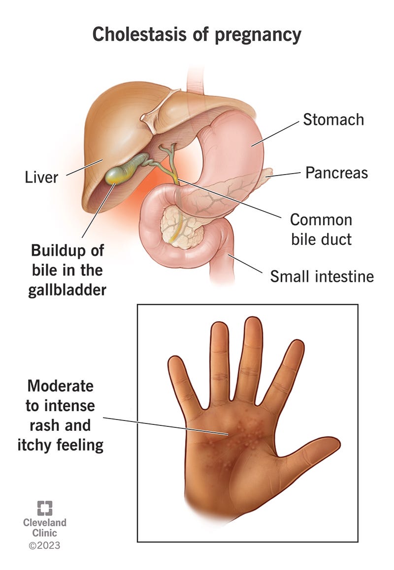 Cholestasis Of Pregnancy: Causes, Symptoms & Treatment