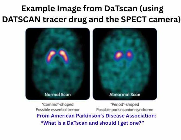Example image from DaTscan for diagnosing Parkinsons
