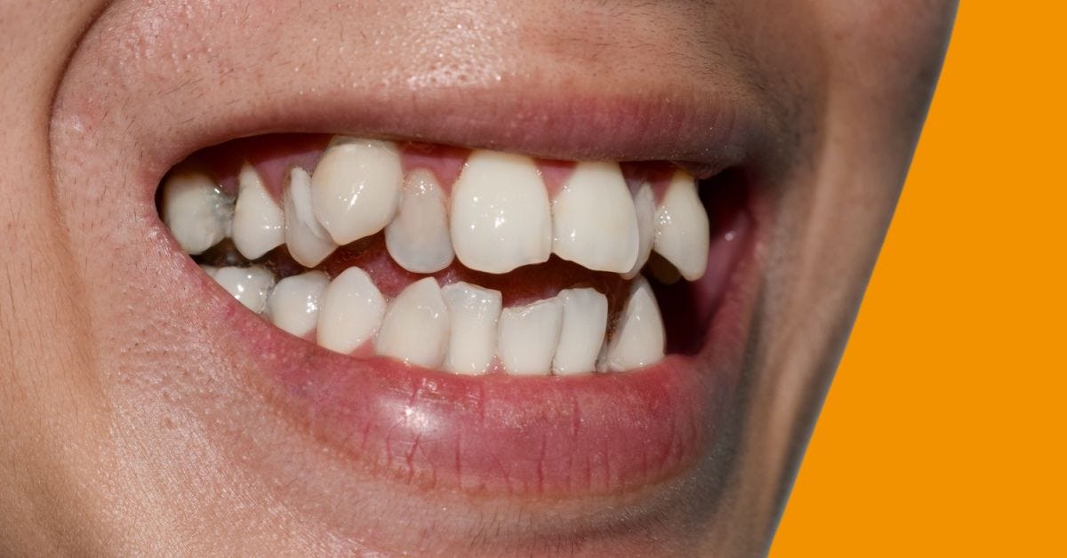 Why Do I Have Crooked Teeth and What Can I Do About It? - Nottingham Smiles