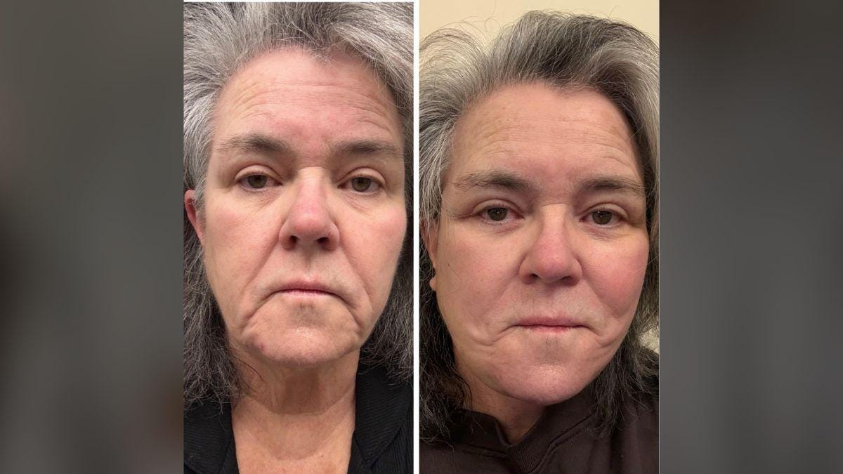 Photo of Rosie O'Donnell said she formerly felt very 'strongly about facelifts.' Photo of Rosie O'Donnell said she formerly felt very 'strongly about facelifts.'