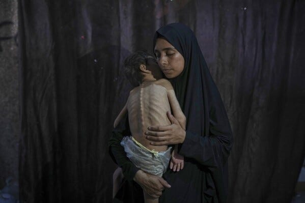Samah Matar poses for a photo with her son Yousef, 6, who suffers from malnutrition and cerebral palsy, at a U.N.-run school in Gaza City, Saturday, July 26, 2025. In Gaza, malnutrition is often worsened by preexisting conditions and compounded by illnesses linked to inadequate health care and poor sanitation, largely the result of the ongoing war. (AP Photo/Jehad Alshrafi)