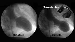 Síndrome de Takotsubo perioperatorio : a propósito de un caso. - AnestesiaR