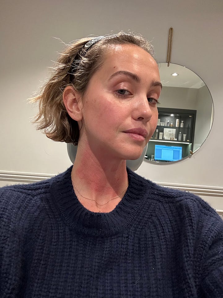 after morpheus 8 treatment