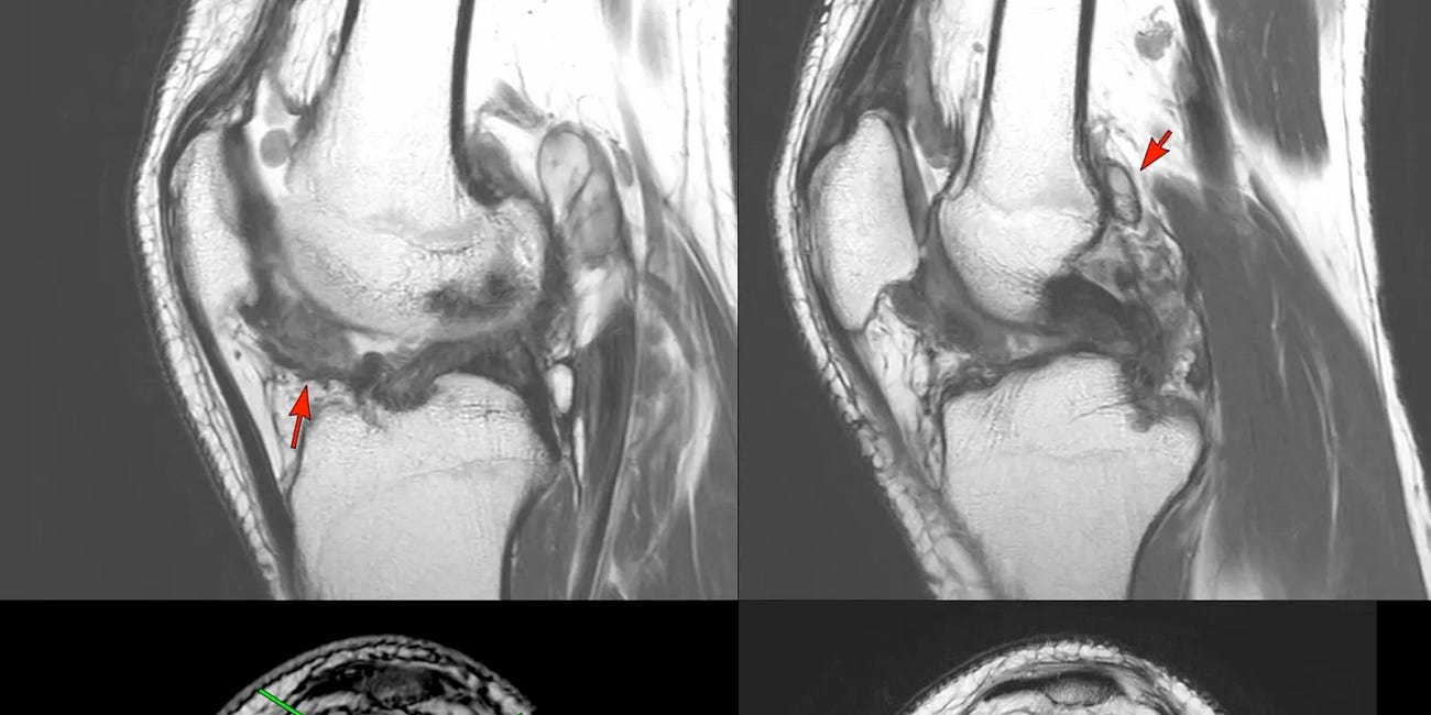 Case 57: Hemosiderin Blooming
