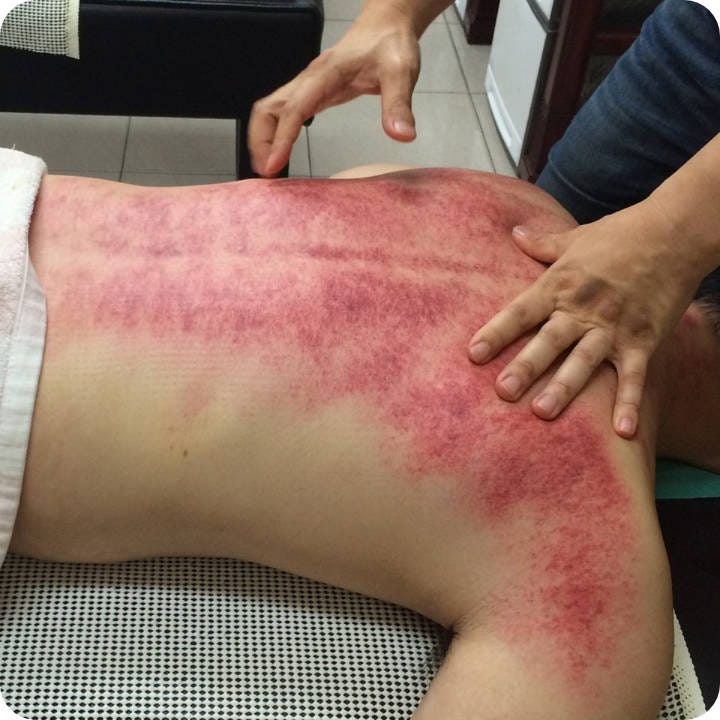 Gua Sha and IASTM - Brisbane MSK Therapy Clinic