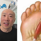 Taylor Decker toe sesamoidectomy surgery analysis from 2024