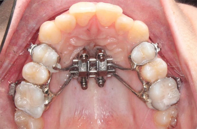 MARPE Procedure For Narrow Maxilla at our Orthodontic Dental Clinic