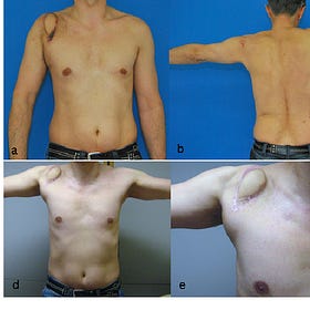 Case Report: Desmoid Tumor (Aggressive Fibromatosis), age 34, Male
