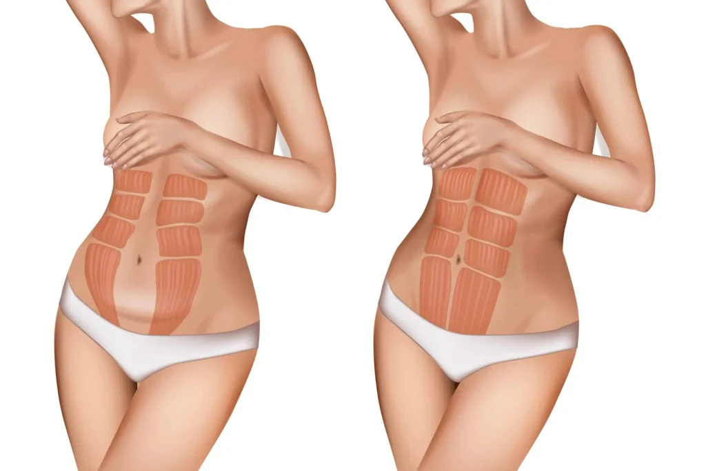 Preventing Diastasis Recti: Core Health Guide - Body Ready Method®