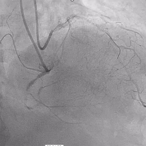 Chronic Total Occlusion of the Right Coronary Artery (RCA) | Navitian
