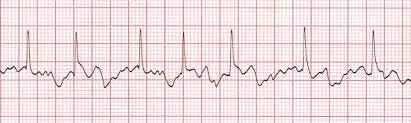 Atrial Fibrillation training - ACLS Cardiac Rhythms video | ProACLS