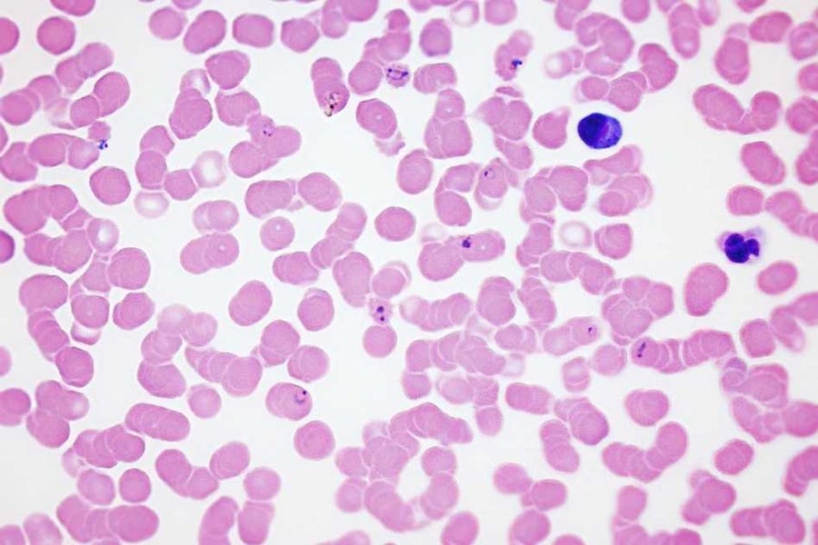 A new way to diagnose malaria | MIT News | Massachusetts Institute of Technology A new way to diagnose malaria | MIT News | Massachusetts Institute of Technology